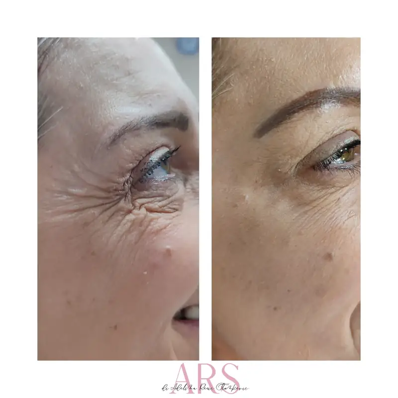Botox tretman oko očiju – Smanjenje bora smejalice – botoks pre i posle, Novi Sad