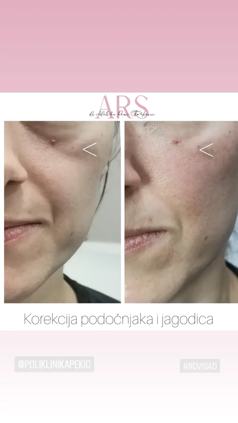 Korekcija podočnjaka i jagodica – pre i posle, Novi Sad