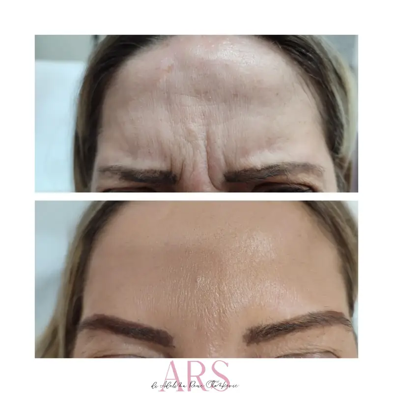 Botox tretman čela – Smanjenje horizontalnih bora čela – botoks pre i posle, Novi Sad
