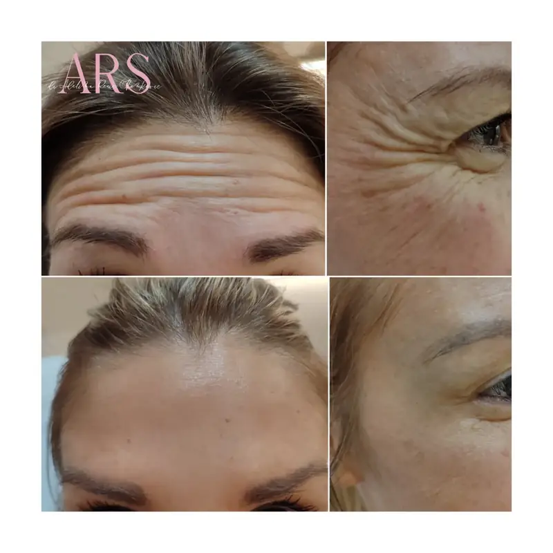 Botox gornje trećine lica – Čelo i područje oko očiju – prirodan, mladolik izgled – botoks pre i posle, Novi Sad