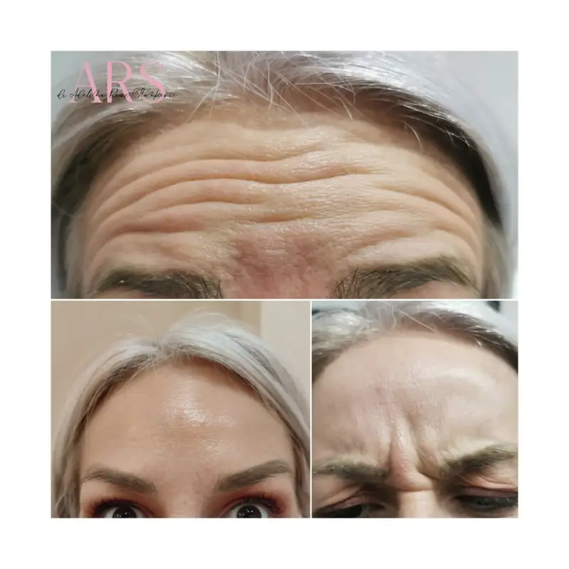 Botox tretman horizontalnih bora – Smanjenje dubokih horizontalnih linija na čelu – botoks pre i posle, Novi Sad